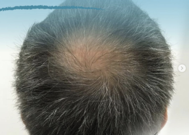 Alopecia en hombres